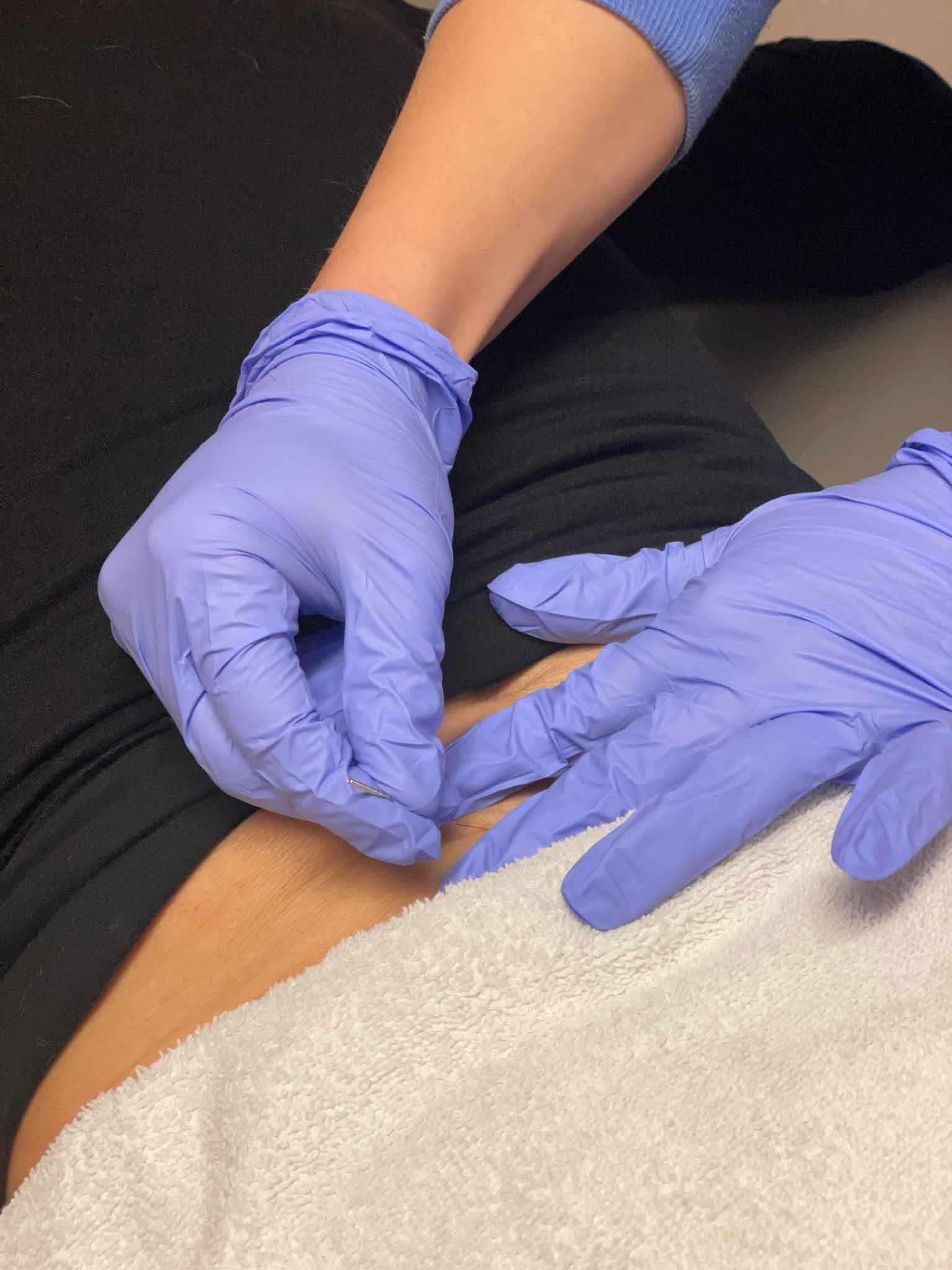 Dr. Claire Watkins, PT, DPT doing physical therapy treatment  Austin Dry Needling